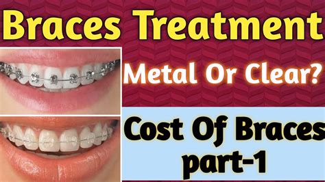 braces treatment cost of braces dental braces treatment part 1