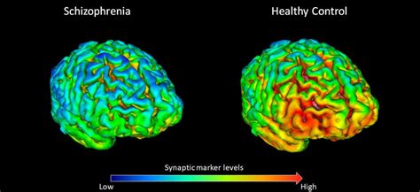 New Imaging Method Reveals Lack Of Key Brain Protein In Schizophrenia