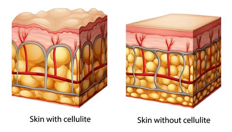 custom cellulite treatment in nj skin care specialist