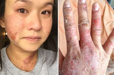 boob job causes such severe eczema that woman left feeling