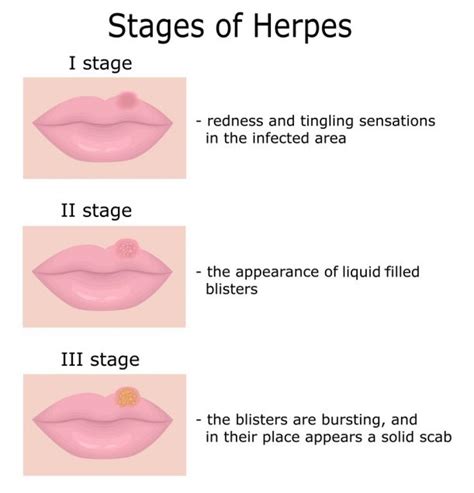 Herpes Herpes Simplex Symptoms Treatment Std Herpes