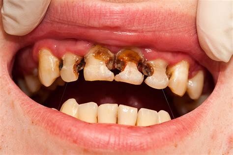 dental cavities symptoms   treatment