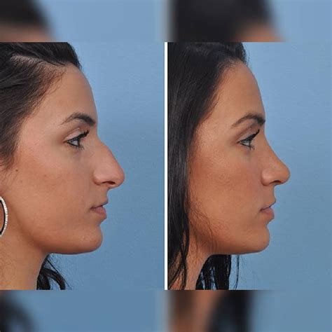 nose job  iran irantreatments plastic surgery  iran