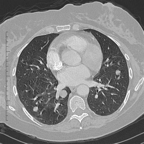 lung metastases  colorectal cancer image radiopaediaorg