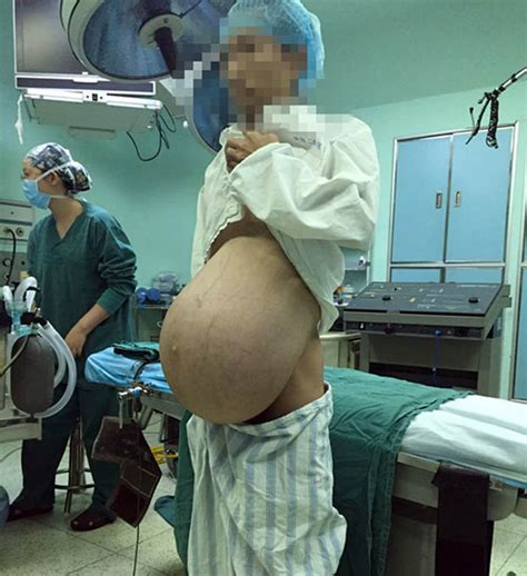 chinese man who looked pregnant for years has massive stomach tumour