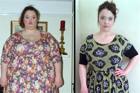 Obese Teen Gets Free Nhs Gastric Bypass And Becomes A