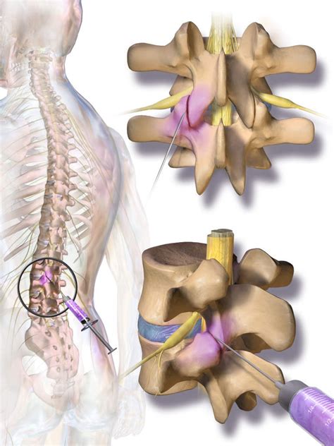 spinal injuries  accidents diagnoses symptoms imaging