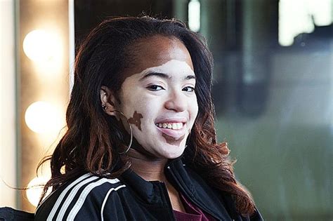 teen with vitiligo spent her life trying to fit in but