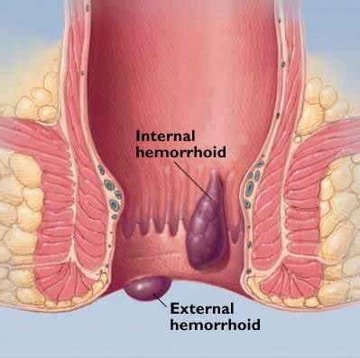 Anal bleeing caused by nyquil