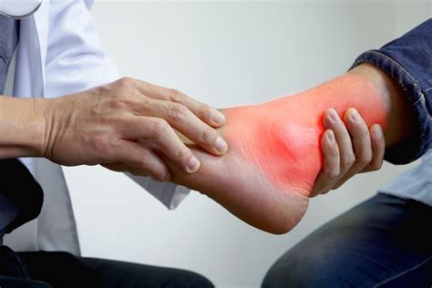 Can Gout Treatment Reduce Complications From Obesity Related Type 2