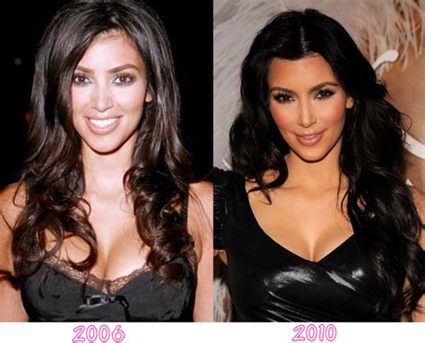 kim kardashian plastic surgery before and after botox