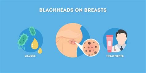 Blackheads On Breasts Causes And Treatments Skincare Hero
