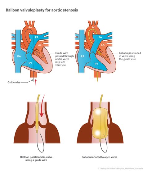 Cardiology Aortic Stenosis As