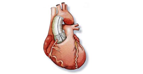 chirurgischer eingriff bei dissektion der aorta einriss