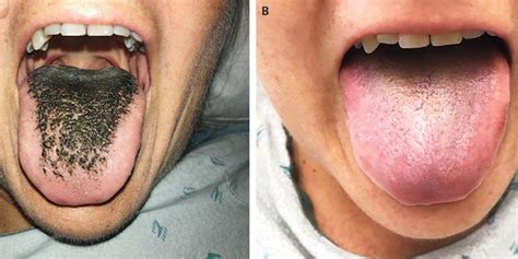 woman had a case of hairy black tongue — here s how it happens