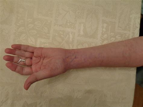 heres  gold  rheutired wrist fusion surgery