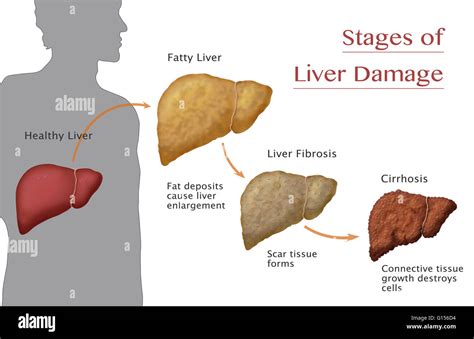 Stages Of Liver Damage Starting From A Healthy Liver Left Deposits