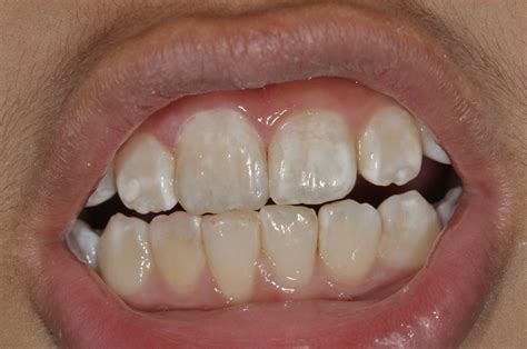 white spots   teeth  solihull coventry