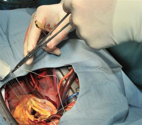 Composite Graft Replacement Of The Aortic Root Ascending Aorta And