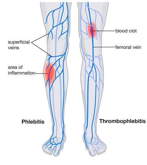 describe blood clot pain  leg gilbertokruwhale