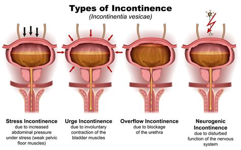 female urinary incontinence symptoms and causes newyork presbyterian
