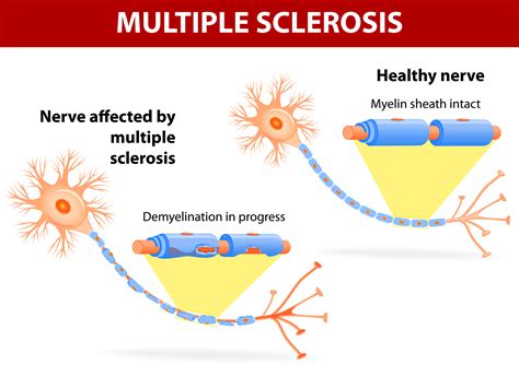 natural relief  symptoms  multiple sclerosis  sacramento body
