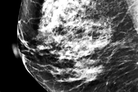 the latest mammogram controversy density wsj
