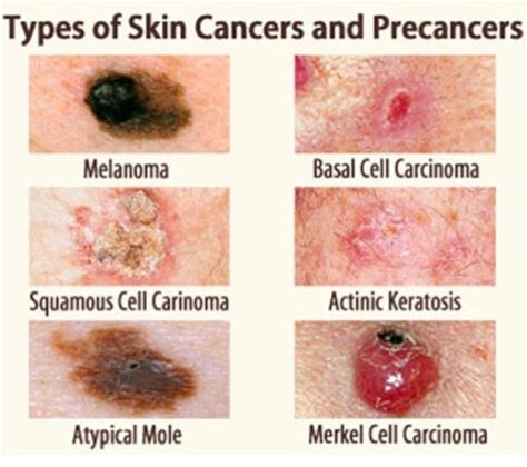 Stage Free Melanoma On Twitter We Know Its Not Pleasant To Look At