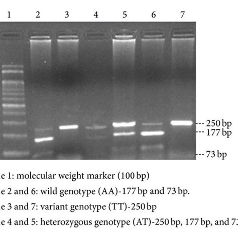 Restriction Band Pattern Of Catalase 21 A T Gene Variant Download