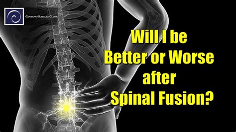 Spinal Fusion Does More Harm Than Good Centeno Schultz Clinic