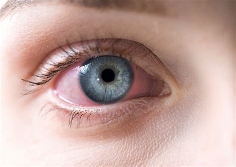 macro  red woman eye bloodshot eye conjunctivitis  allergic reaction