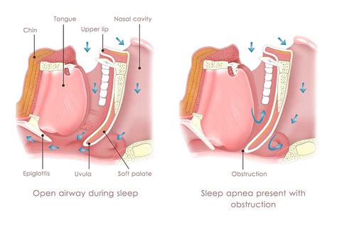 Obstructive Sleep Apnea Oc Ent Clinic Sinus Surgery Septoplasty