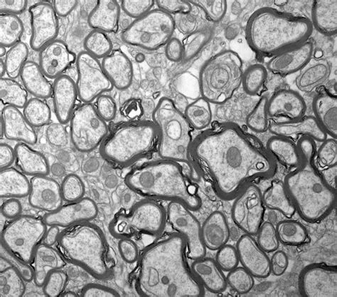 mechanisms identified  restore myelin sheaths  injury   multiple sclerosis