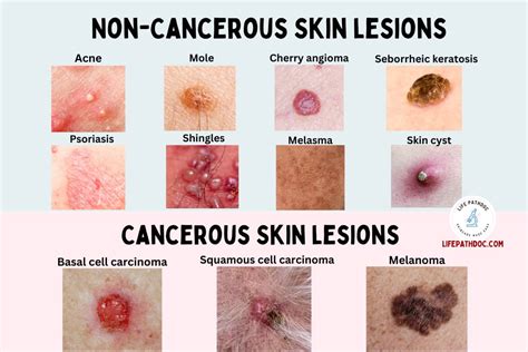 skin lesions types  chart pictures  treatment