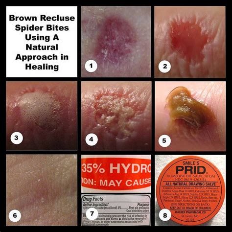 poisonous spider bite timeline brown recluse spider