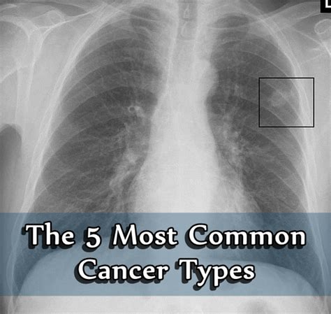 common cancer types hubpages
