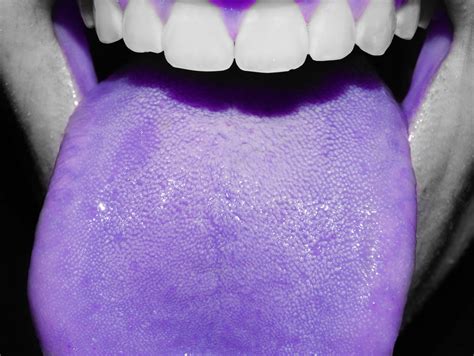 purple bump  tongue