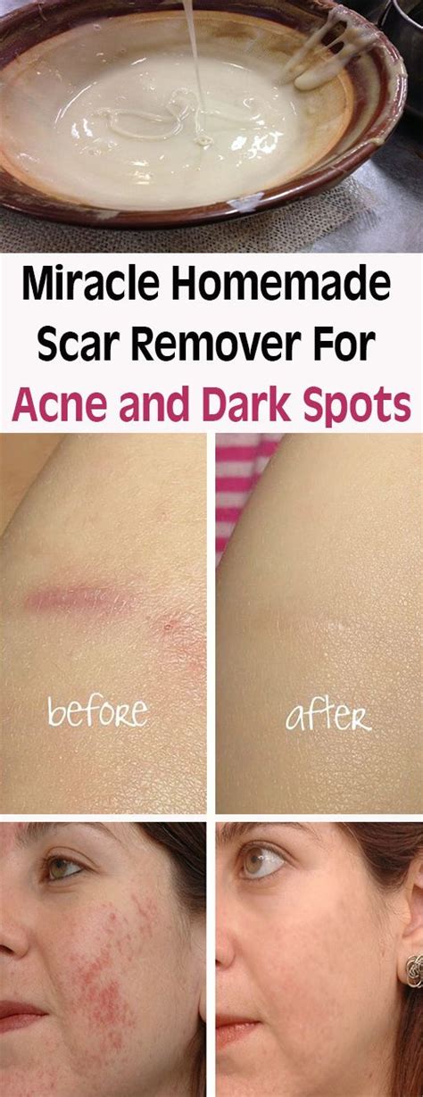 miracle homemade scar remover for acne and dark spots let s tallk