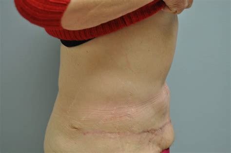Before And After Tummy Tuck Abdominoplasty And After