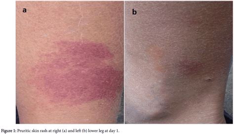 clinical experimental dermatology skin rash right