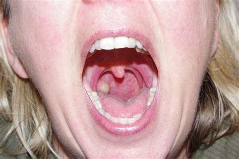 tonsillitis symptoms  complications  risk factors