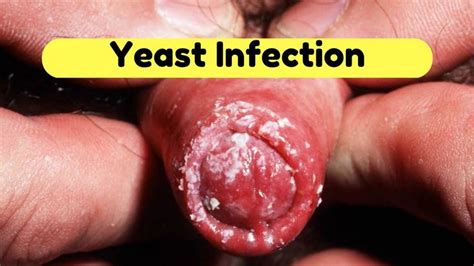 January 16 2012 Best Yeast Infection Tips