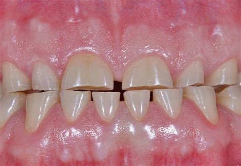 worn teeth rejuvenation  porcelain veneers smile concepts