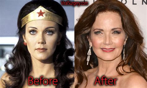 Lynda Carter Plastic Surgery Before And After Facelift