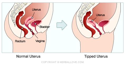 Intercourse Pain Caused By A Tipped Uterus