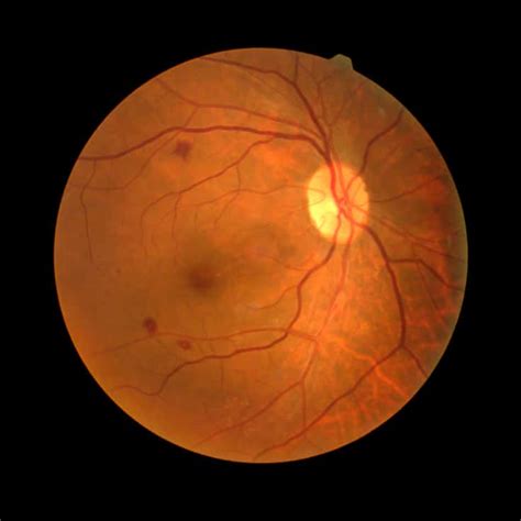 diabetic retinopathy prevention management  natural