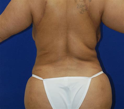 brazilian butt lift before and after plastic surgery