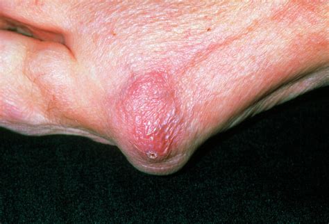 rheumatoid arthritis nodule photograph by dr p marazzi science photo