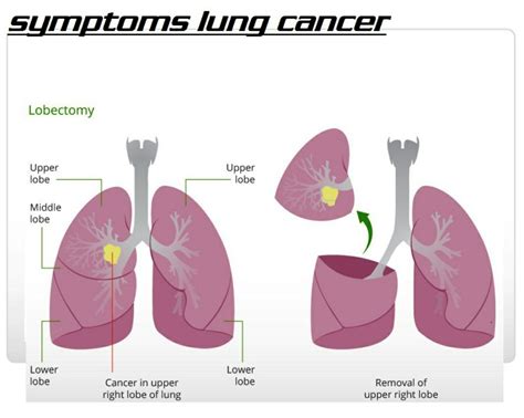 cancer  upper  lobe  lung medicinebtgcom