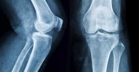 What Are The Treatments For Bone Spurs On The Leg Bone Livestrong